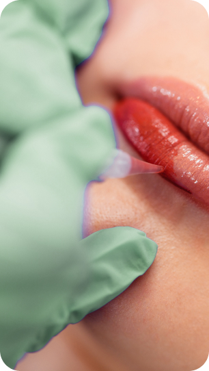 Best Lip Filler Brisbane