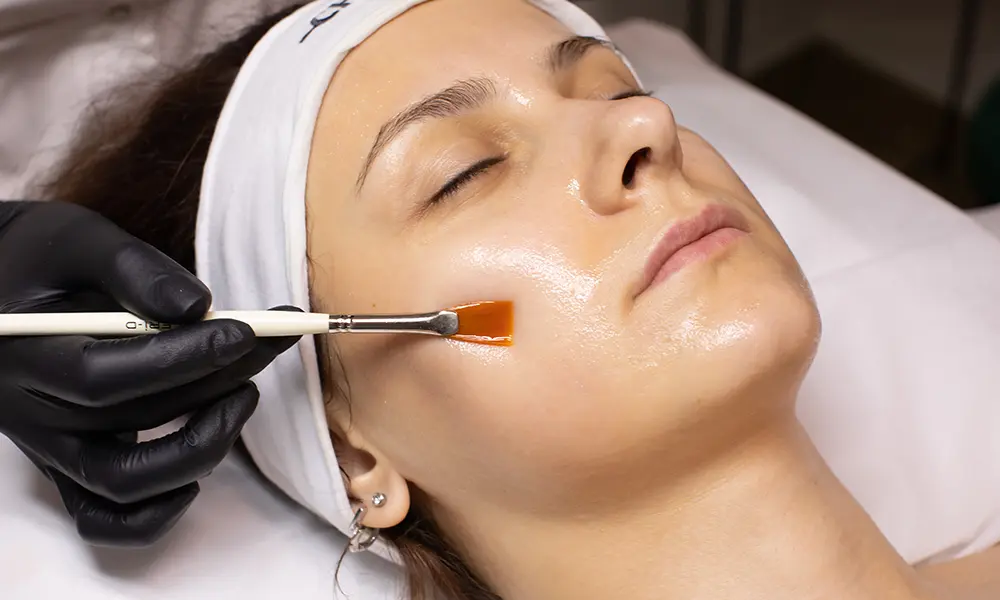 chemical peel side effects