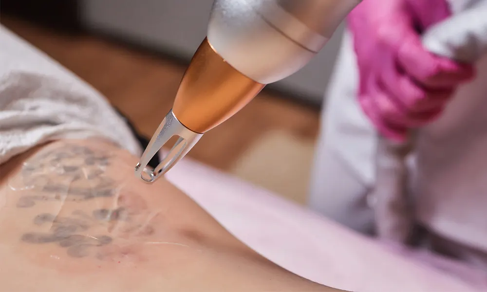 remove-cosmetic-tattoos